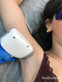 Depilação a Laser
